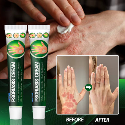Psoriasis cream